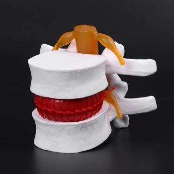 Анатомическая модел херния на лумбалните на междупрешленния диск на човека, медицински наръчник, анатомический инструмент, директна доставка - Изображение 2  